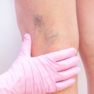 Wzmocnienie i tonizacja ścian żylnych